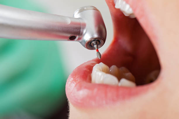 Best Broken or Cracked Tooth Emergency Dentist in Sugarcreek, OH